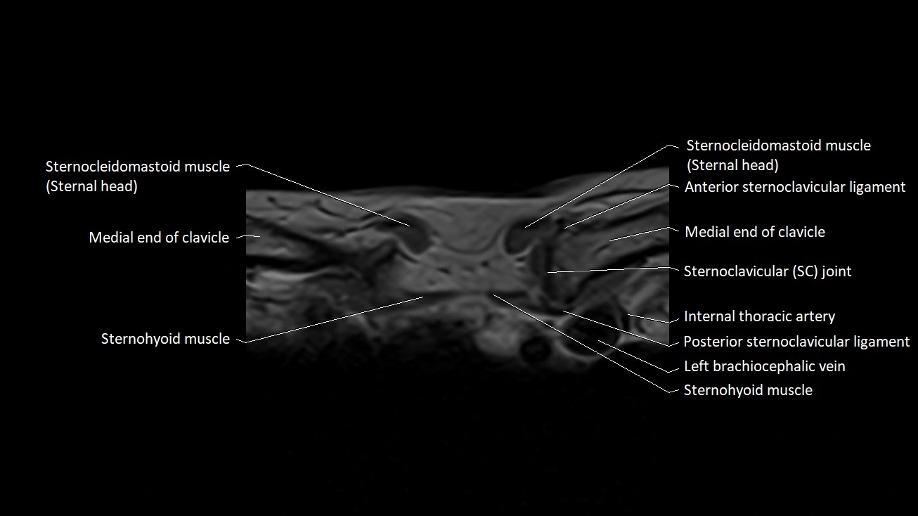 MRI sternum and sternoclavicular joint labeled axial anatomy image 2.webp